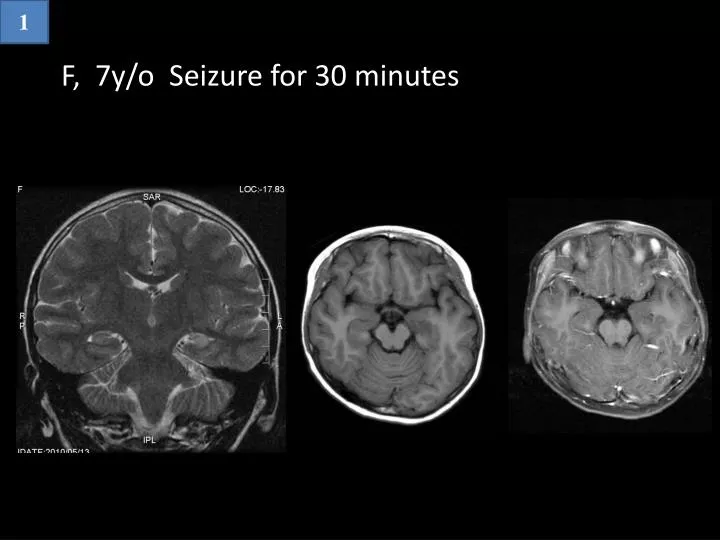 f 7y o seizure for 30 minutes