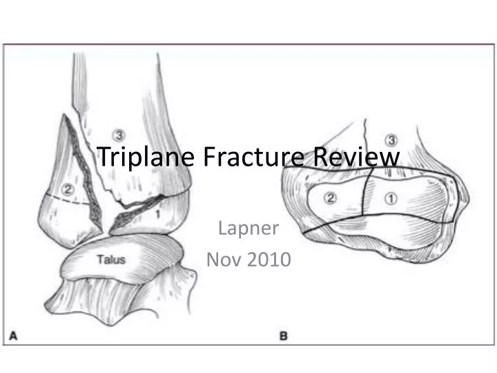 triplane fracture review