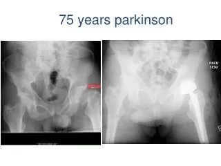 75 years parkinson