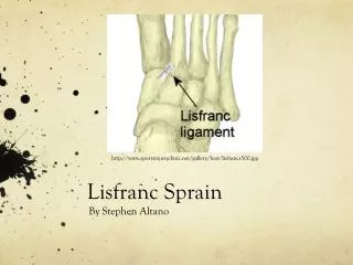 Lisfranc Sprain