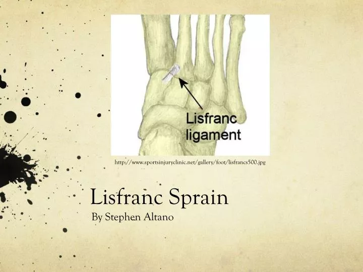 lisfranc sprain