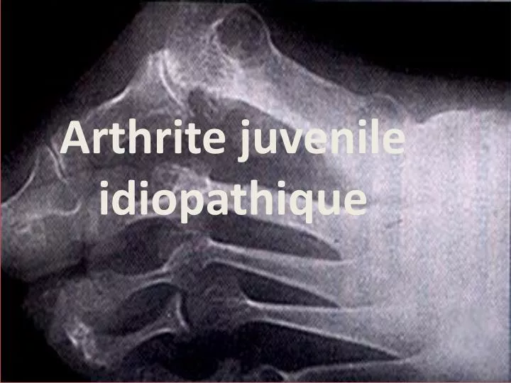 arthrite juvenile idiopathique
