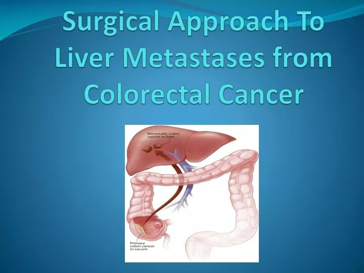 surgical approach to liver metastases from colorectal cancer