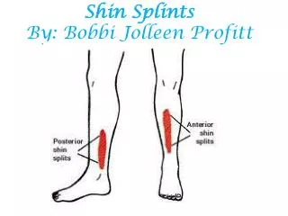 Shin Splints By: Bobbi Jolleen Profitt
