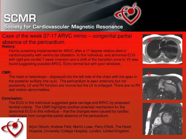 case of the week 07 17 arvc mimic congenital partial absence of the pericardium