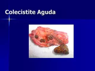 colecistite aguda