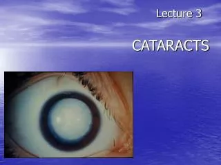 Lecture 3 CATARACTS
