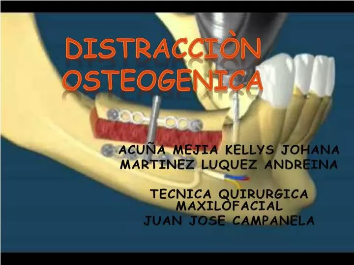 distracci n osteogenica