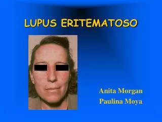 lupus eritematoso