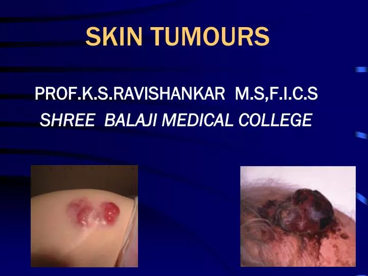 skin tumours