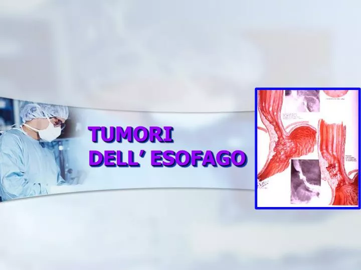 tumori dell esofago
