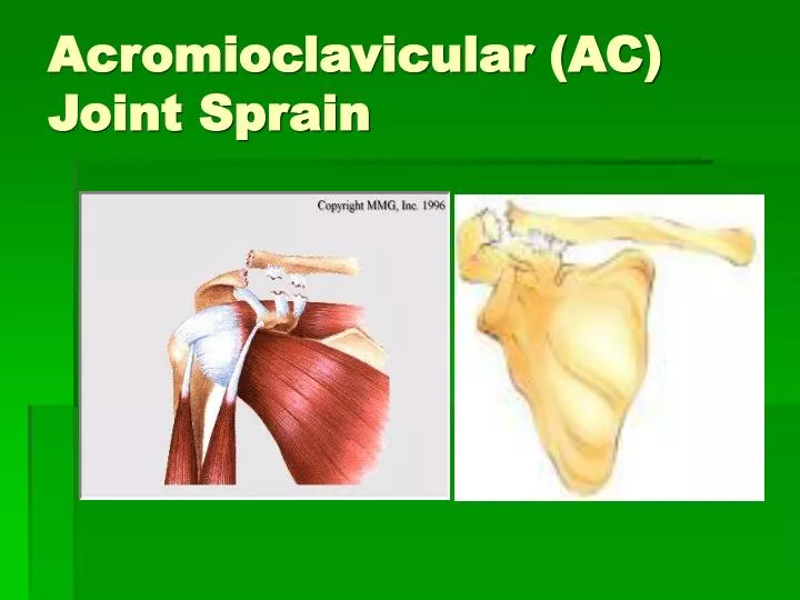 acromioclavicular ac joint sprain