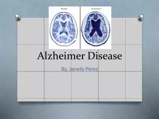 Alzheimer D isease