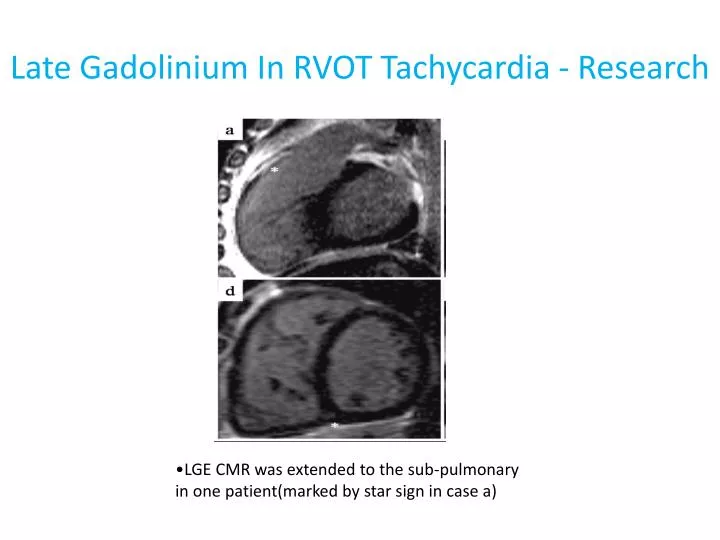 late gadolinium in rvot tachycardia research