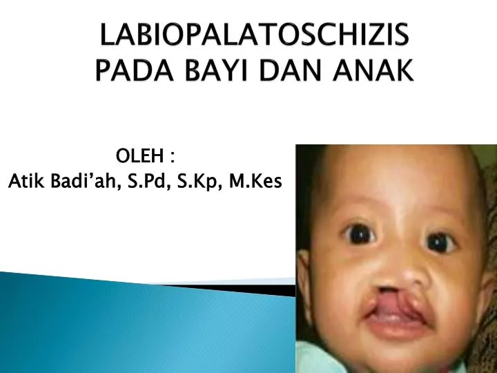 labiopalatoschizis pada bayi dan anak