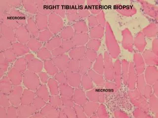 Muscle Biopsy (right TA)