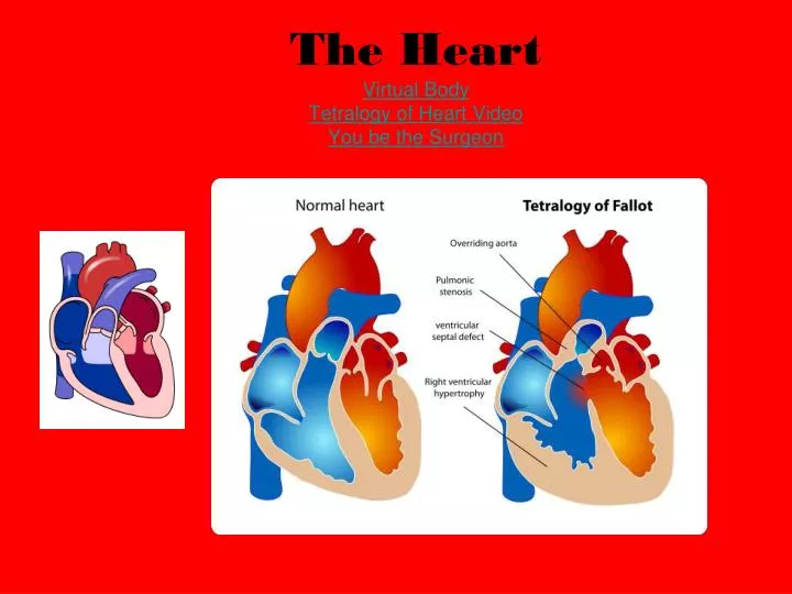 the heart virtual body tetralogy of heart video you be the surgeon