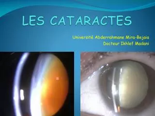 les cataractes