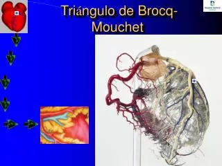 tri ngulo de brocq mouchet