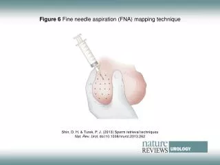 Figure 6 Fine needle aspiration (FNA) mapping technique