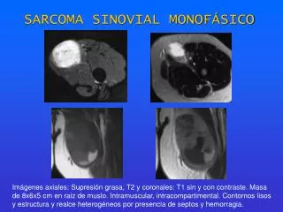sarcoma sinovial monof sico