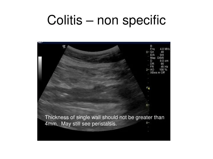 colitis non specific