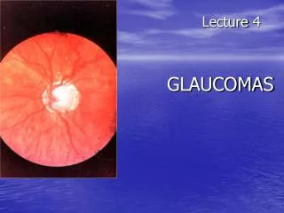 Lecture 4 GLAUCOMAS