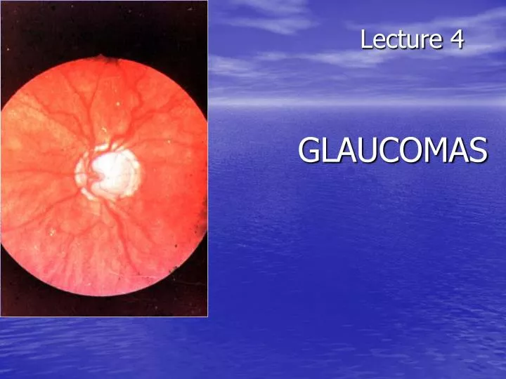 lecture 4 glaucomas