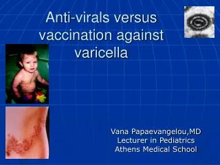 Anti-virals versus vaccination against varicella