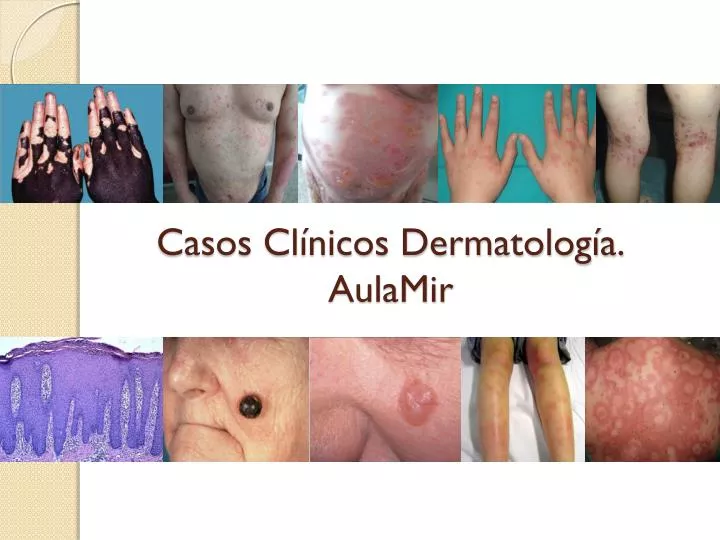 casos cl nicos dermatolog a aulamir