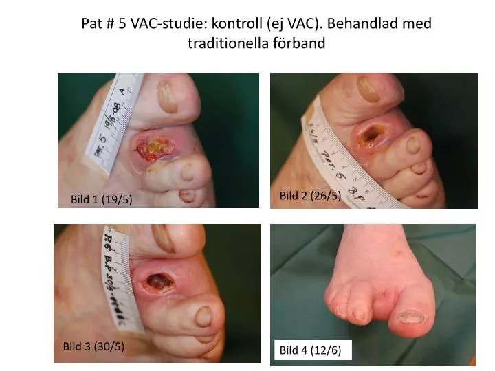 pat 5 vac studie kontroll ej vac behandlad med traditionella f rband