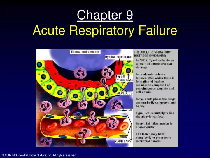 chapter 9 acute respiratory failure