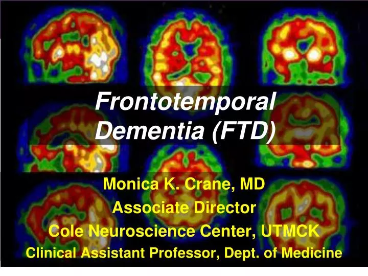 frontotemporal dementia ftd