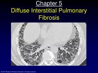 Chapter 5 Diffuse Interstitial Pulmonary Fibrosis
