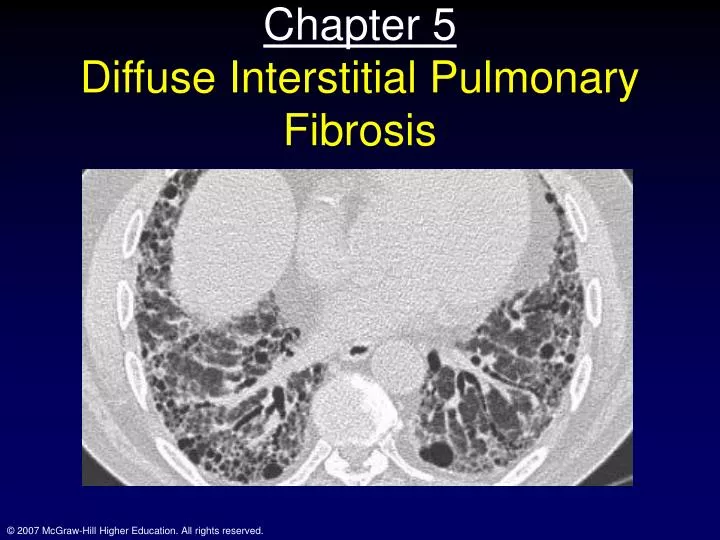 chapter 5 diffuse interstitial pulmonary fibrosis