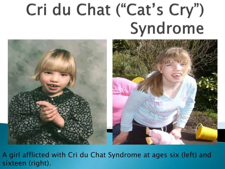 cri du chat cat s cry syndrome
