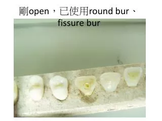 open round bur fissure bur