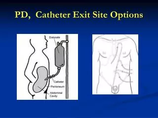 PD, Catheter Exit Site Options