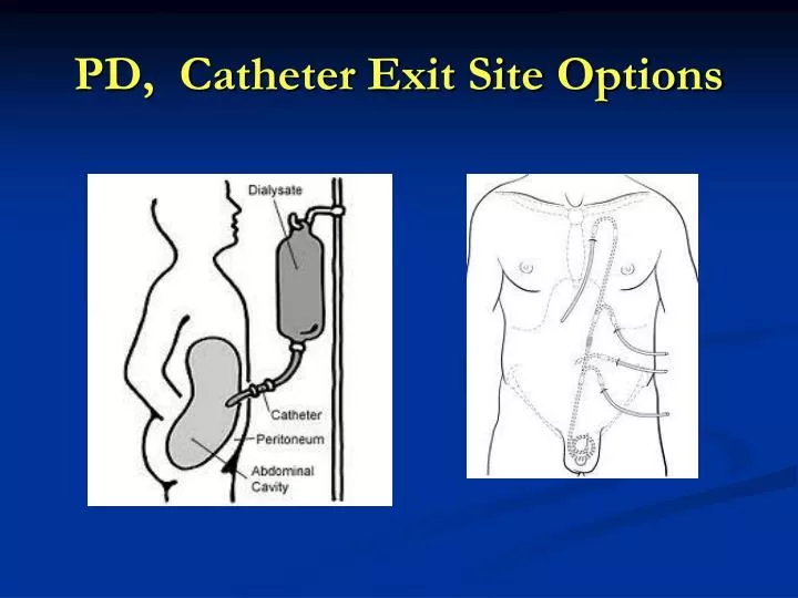 pd catheter exit site options