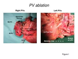 PV ablation