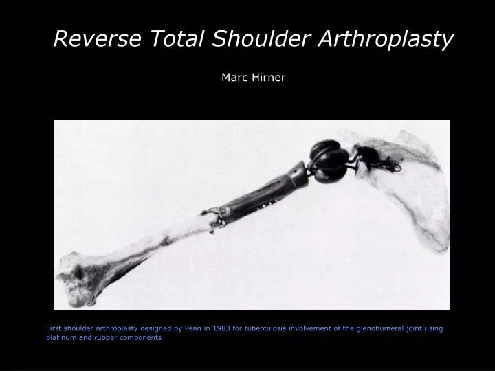 first shoulder arthroplasty