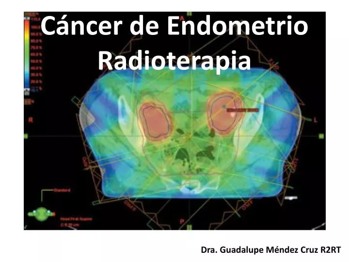 c ncer de endometrio radioterapia