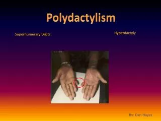 Polydactylism