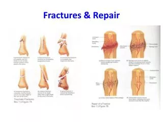 Fractures &amp; Repair