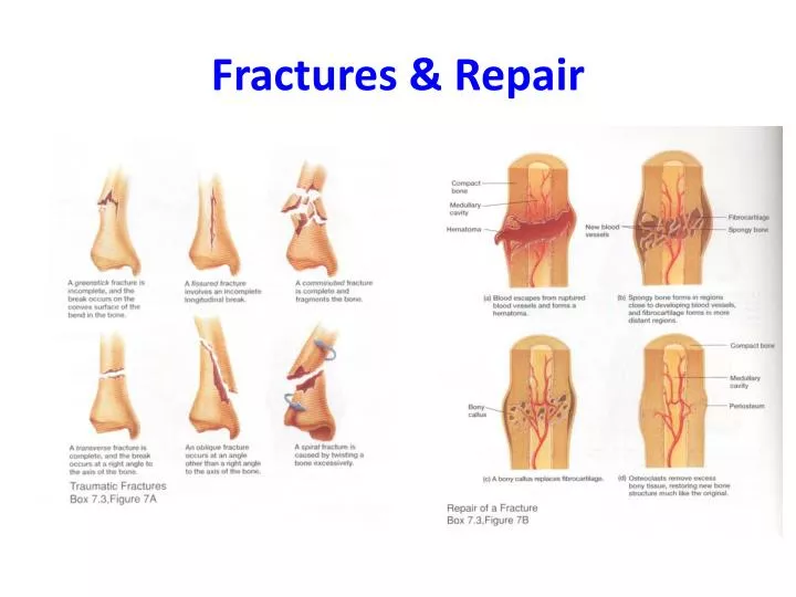 fractures repair