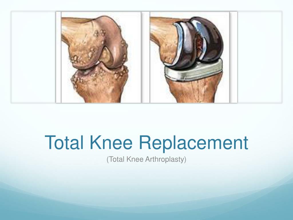 PPT - Total Knee Replacement PowerPoint Presentation, free download ...