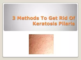 3 Methods To Naturally Treat Keratosis Pilaris