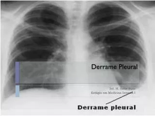derrame pleural