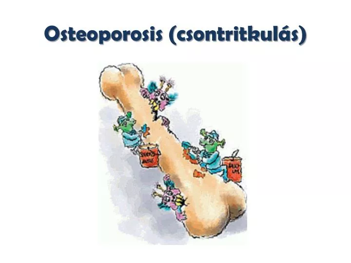 osteoporosis csontritkul s