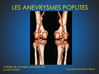 les anevrysmes poplites
